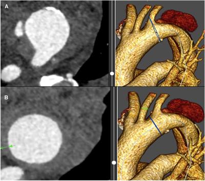 Intramural hematoma in the proximal sealing zone of the thoracic endovascular aneurysm repair: frequency and safety in acute and subacute type B dissections